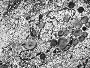 F, 45y. | necrobiosis lipoidica